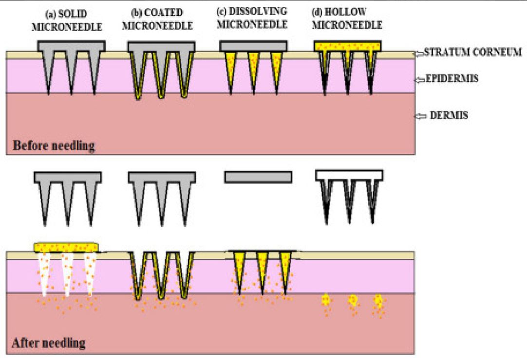 Recent Advancements in Microneedle Technology for Multifaceted Biomedical Applications