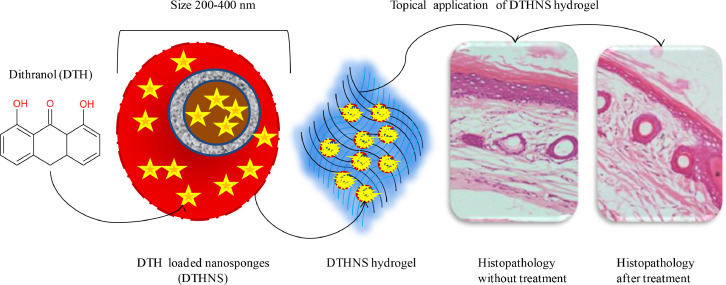 A new perspective for psoriasis_Dithranol nanosponge loaded hydrogels