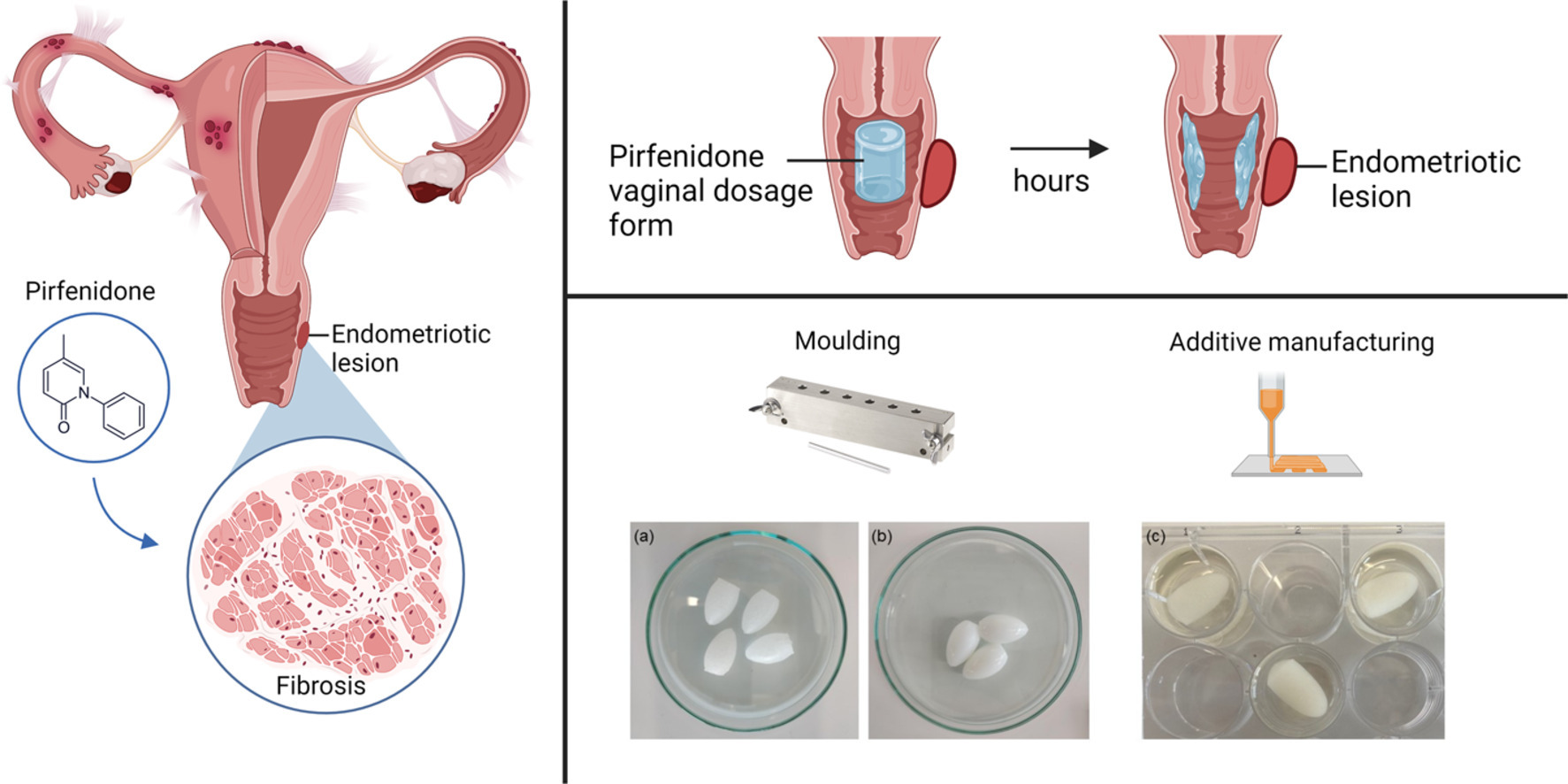 Mucoadhesive 3D printed vaginal ovules to treat endometriosis and fibrotic uterine diseases