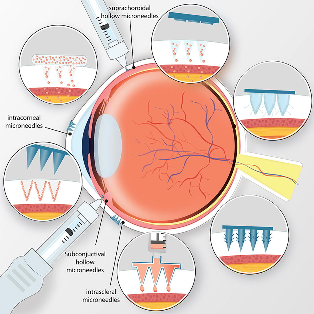 Microneedles for advanced ocular drug delivery